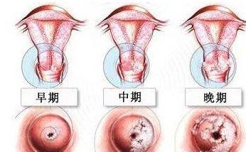 宫颈息肉的危害都有哪些(图1)